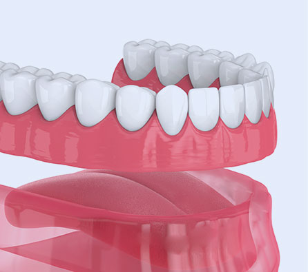 Denture_image